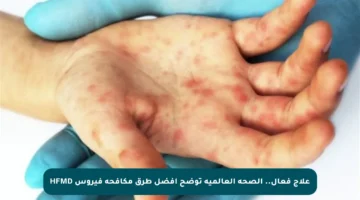 علاج فعال.. الصحة العالمية توضح أفضل طرق مكافحة فيروس HFMD